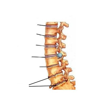 Etapy rozwoju osteochondrozy