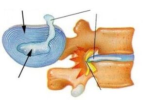 Zniszczenie włóknistego pierścienia z osteochondrozą szyjki macicy