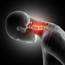 Osteochondroza szyjka macicy